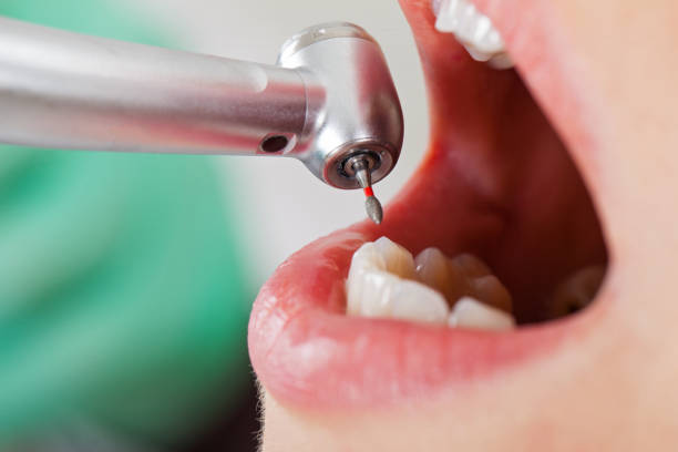 Best Emergency Wisdom Tooth Extraction in USA